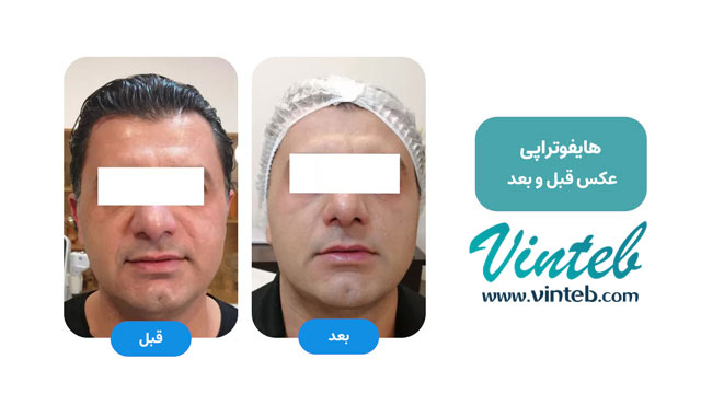قبل و بعد هایفوتراپی