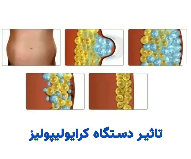 عملکرد کرایولیپولیز